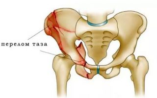Переломы таза у спортсменов