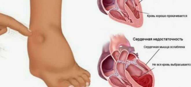 Диагностика анасарка