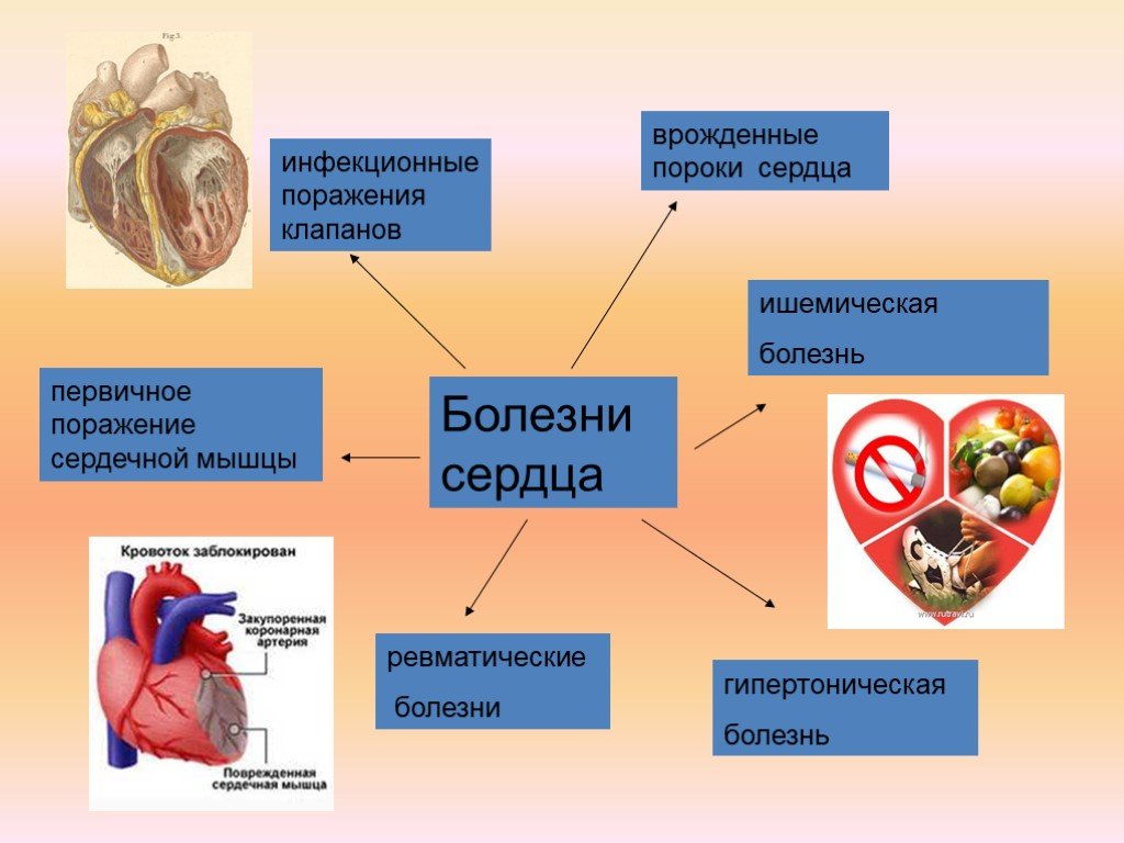 Болезни сердца