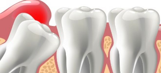 Удаление зубов