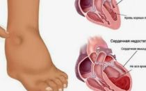 Диагностика анасарка